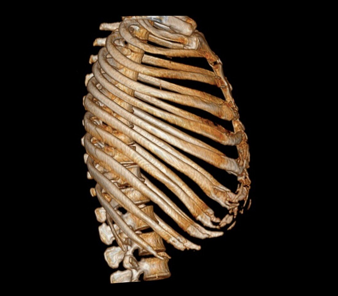 Rib Cage D Ct Scan Bild Kaufen Science Photo Library