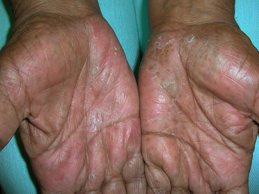 Dyshidrotic Eczema Bild Kaufen 13671926 Science Photo Library