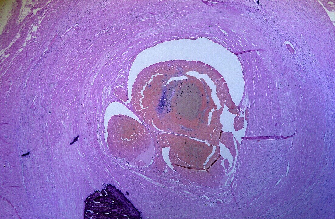 Artery with greasy Blood vessel Circulatory tissue