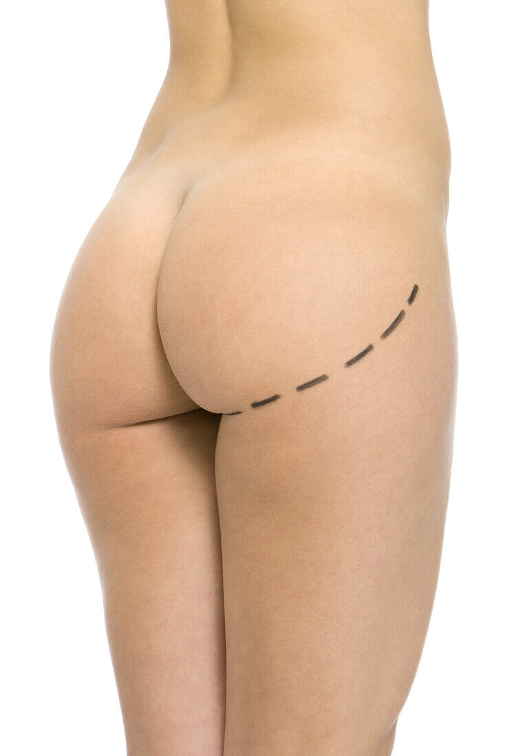 Nude woman with plastic surgery markings on buttocks, cropped view