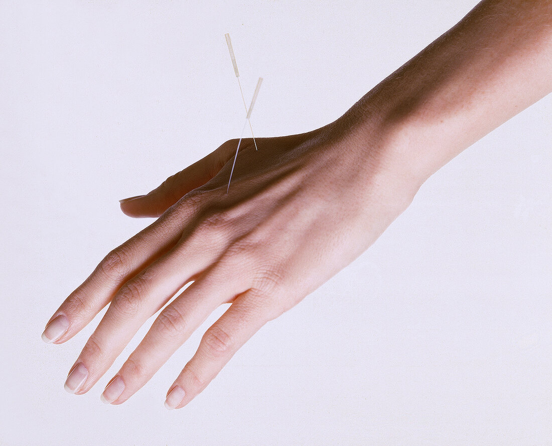 Auf dem Handrücken gesetzte Akupunkturnadeln