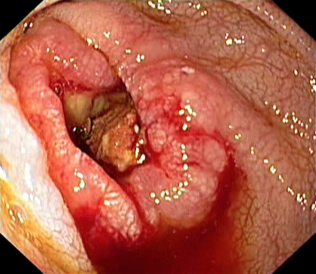 Cancer of the duodenum