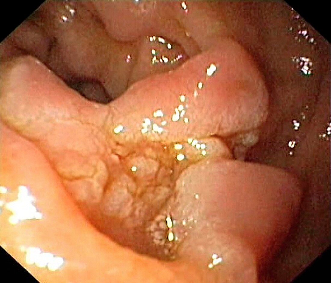 Benign polyp in the duodenum