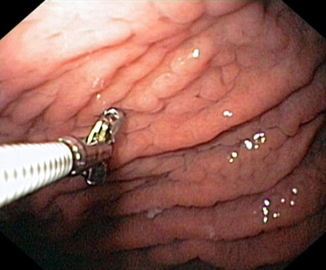 Bacterial stomach infection