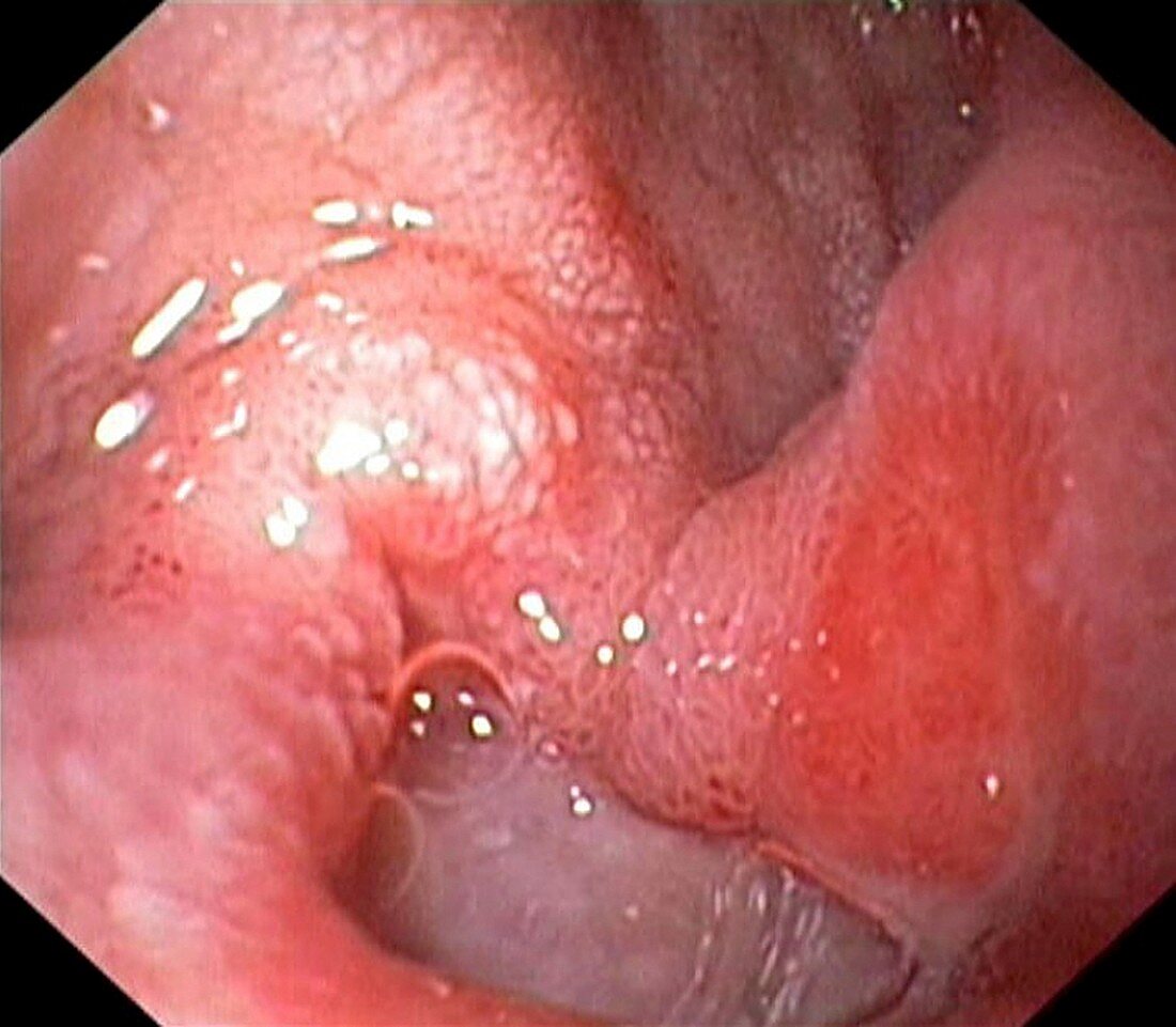 Duodenal ulcer