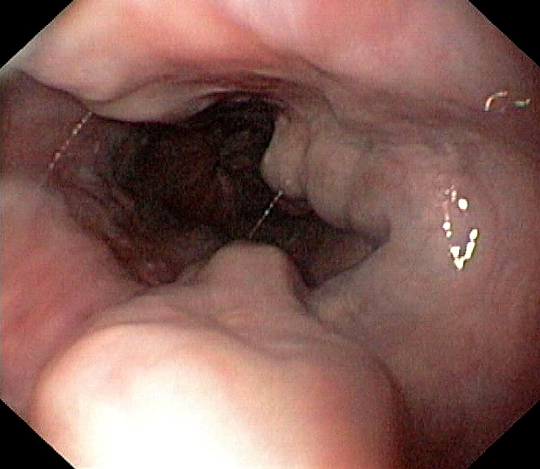 Oesophageal varicose veins