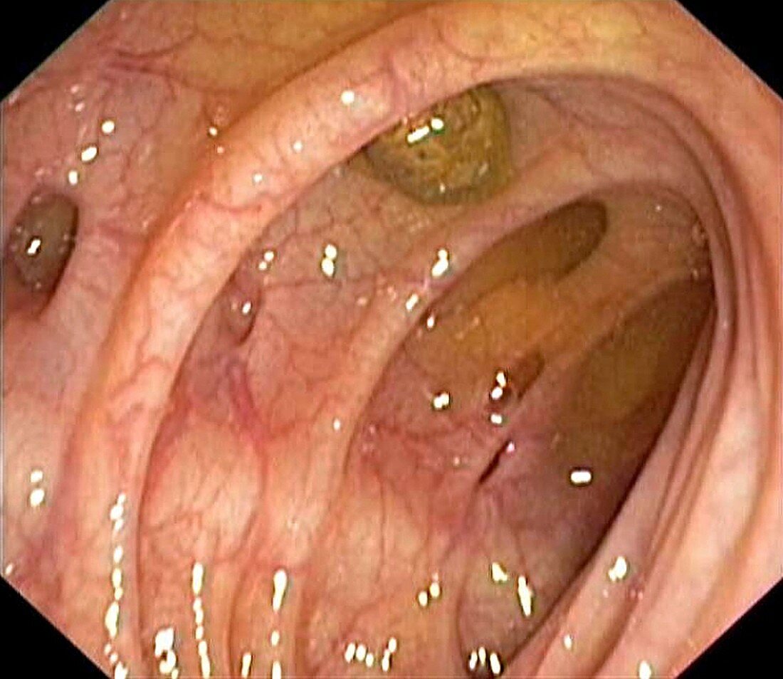 Diverticular disease of the colon