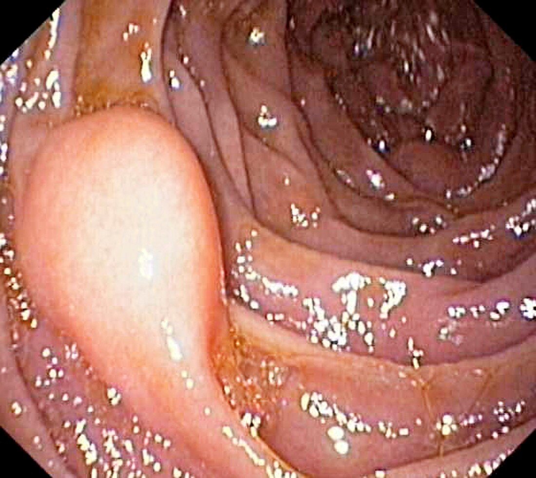 Benign tumour of the small intestine