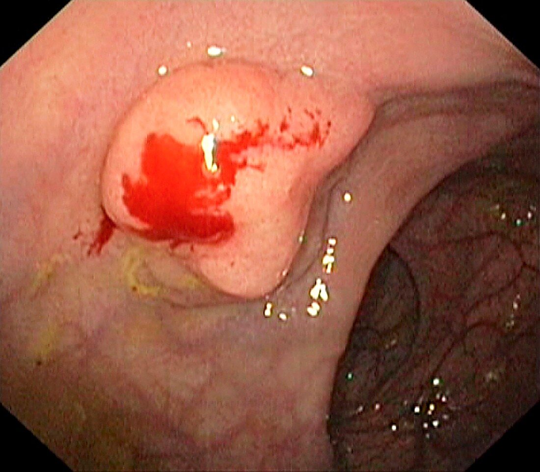 Polyp in the rectum
