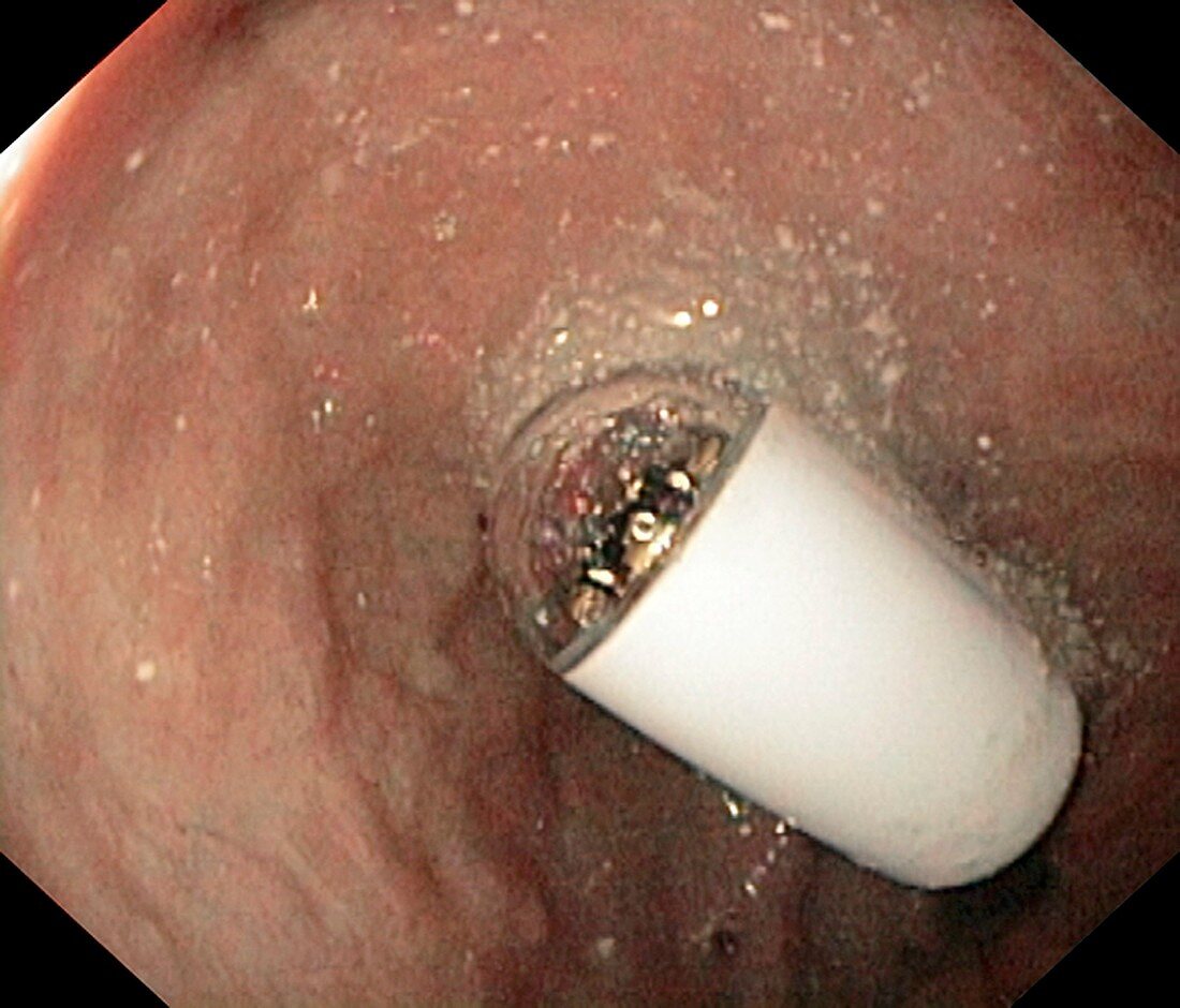 Capsule endoscope in the duodenal bulb