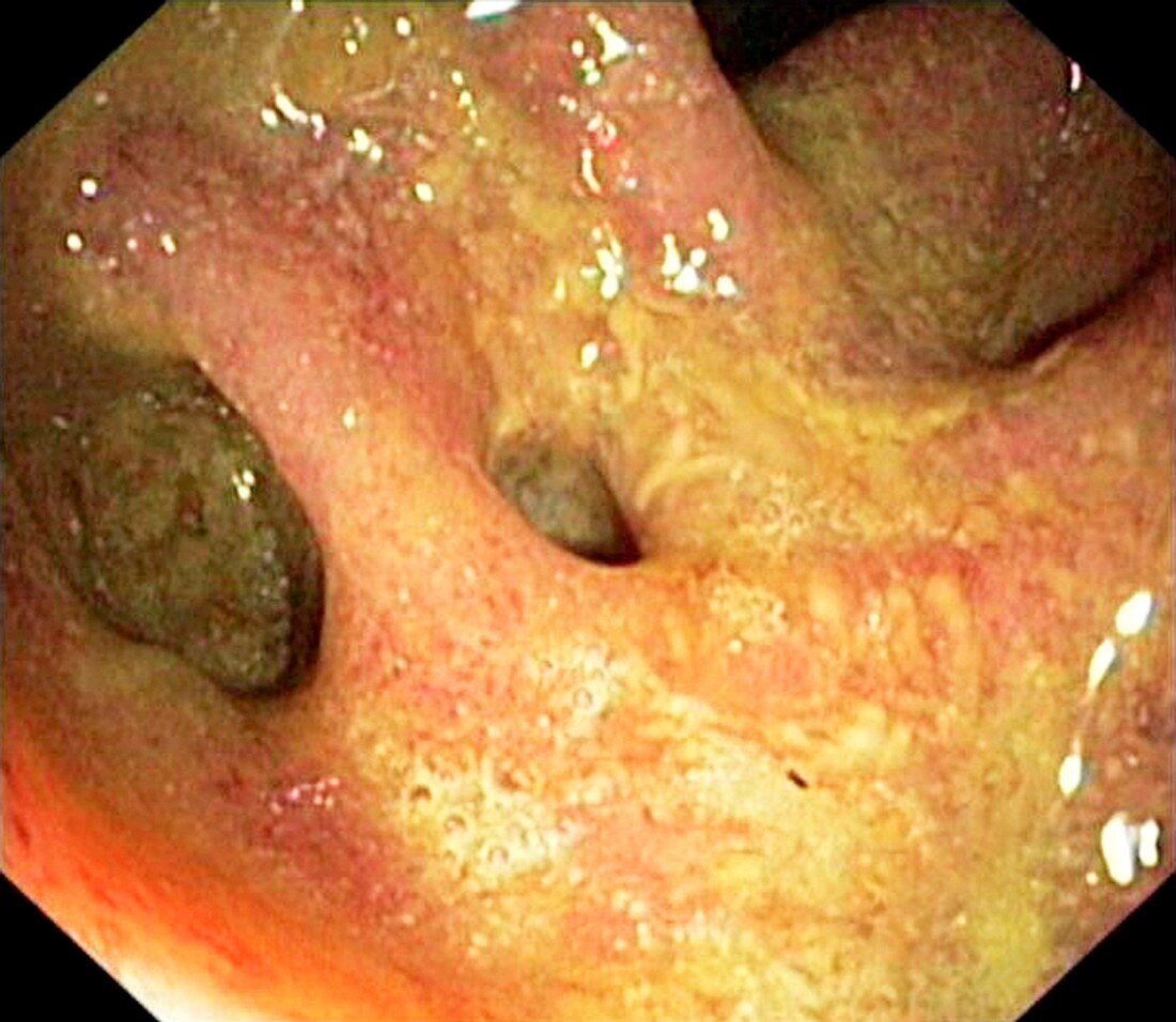 Bowel disease in the colon