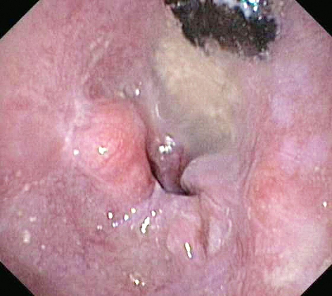 Oesophageal cancer