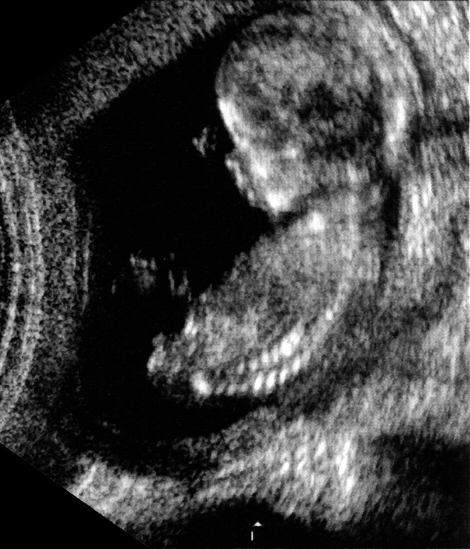 Foetus at 13 weeks,ultrasound