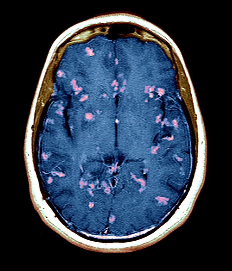 Diseased brain,MRI scan