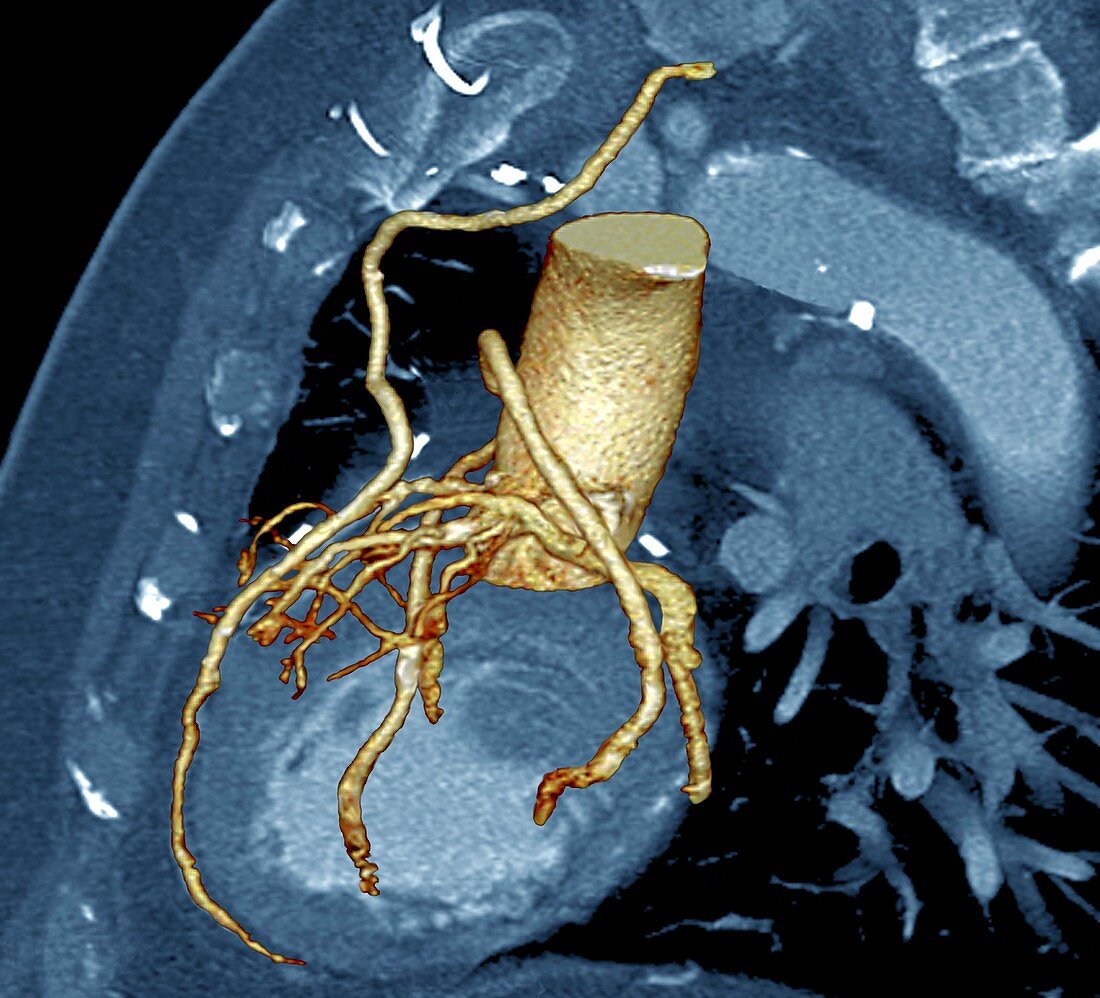 Heart bypass,3D CT scan