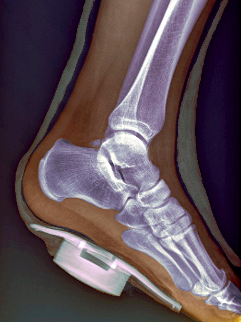 Immobilised ankle,X-ray