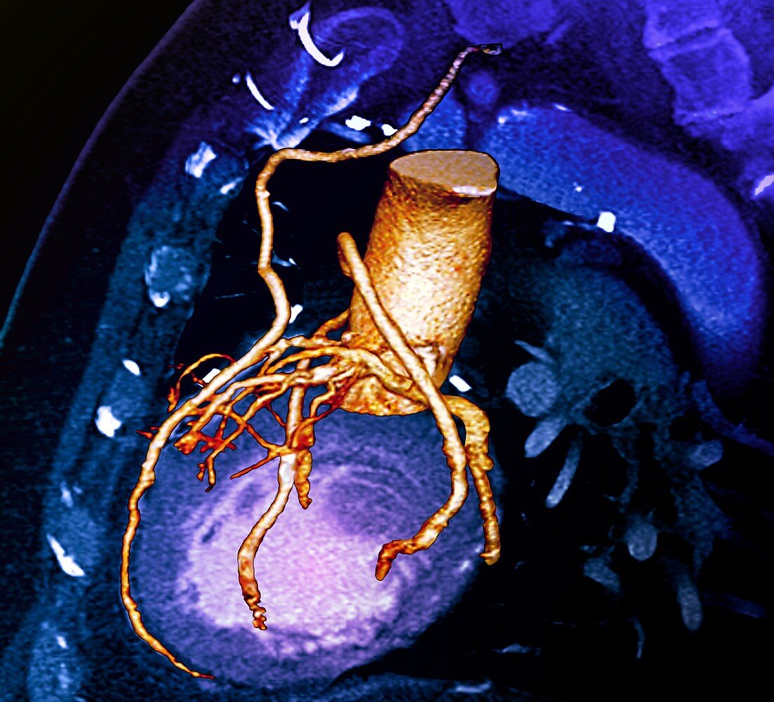 Heart bypass,3D CT scan