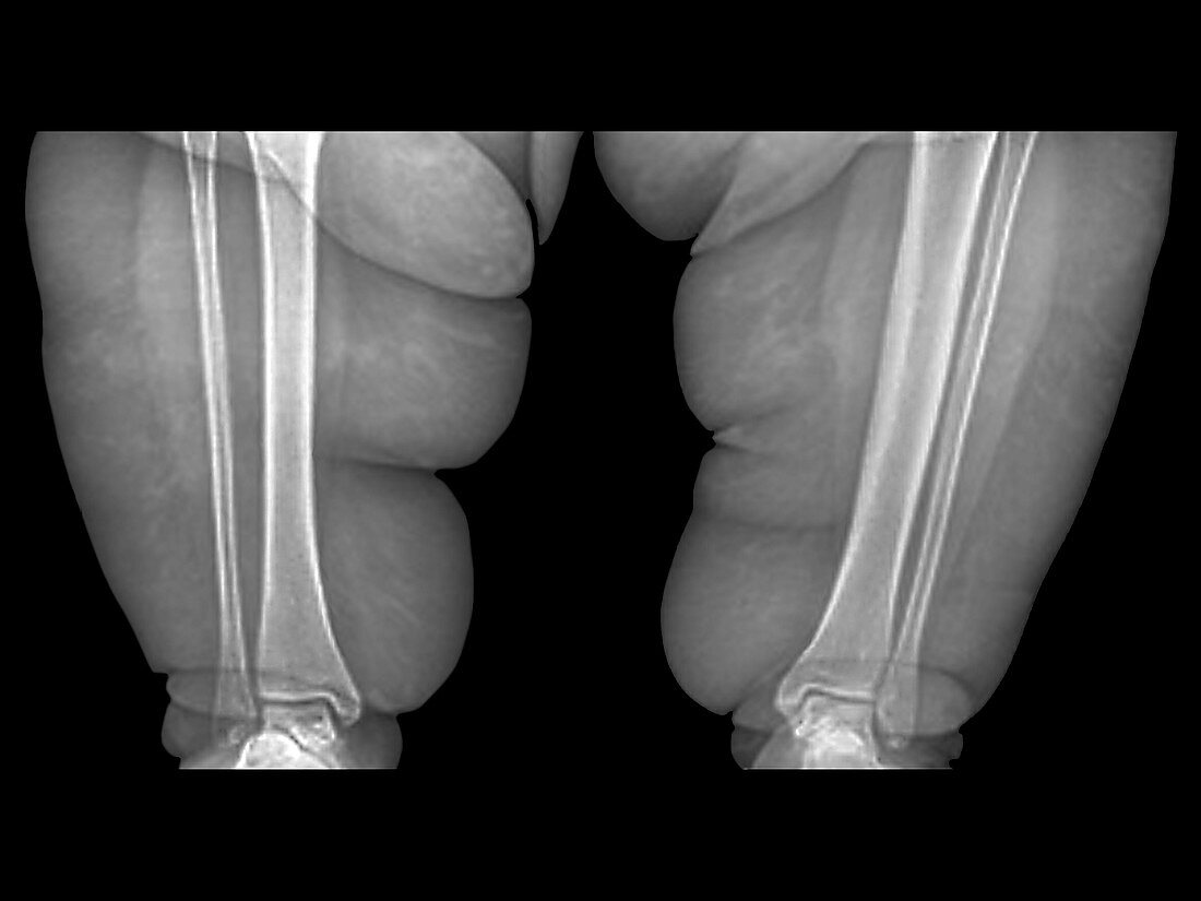Obese person's leg,X-ray