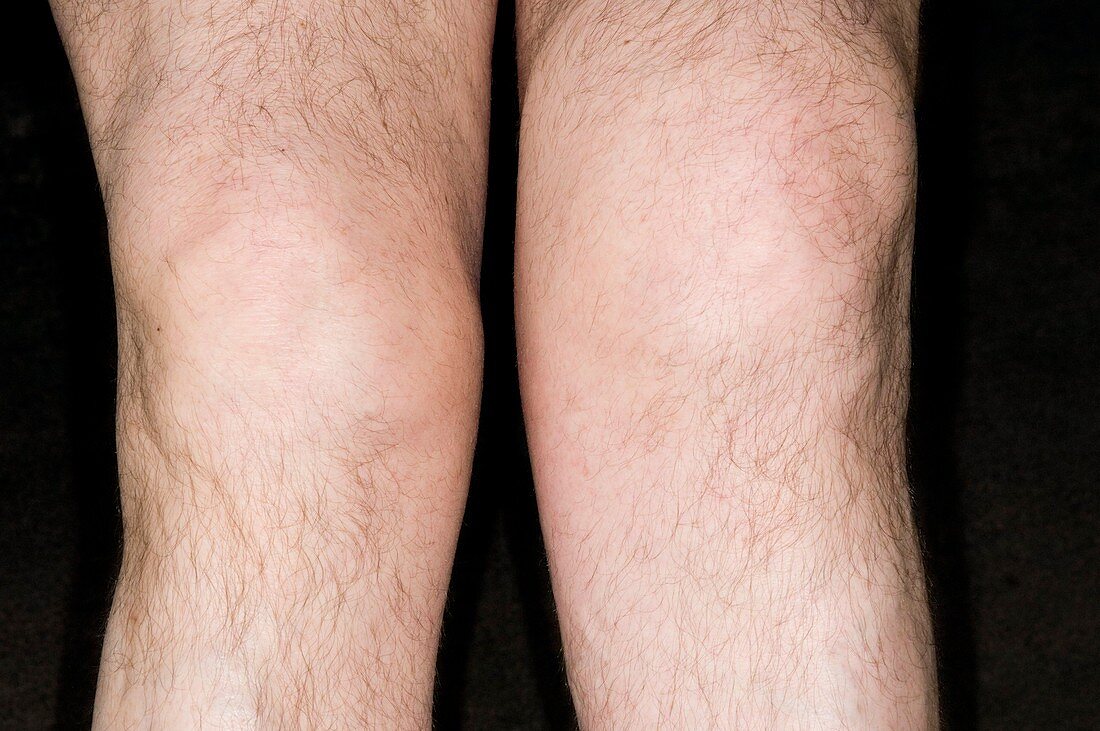 Swollen knee