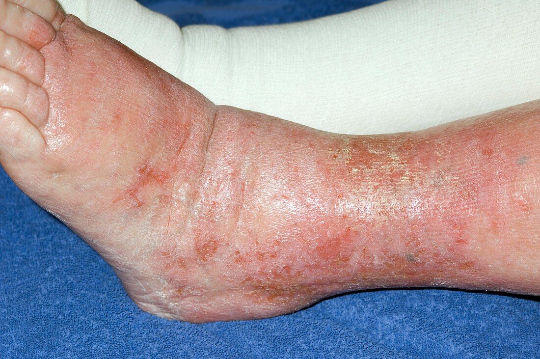 Cellulitis of the leg