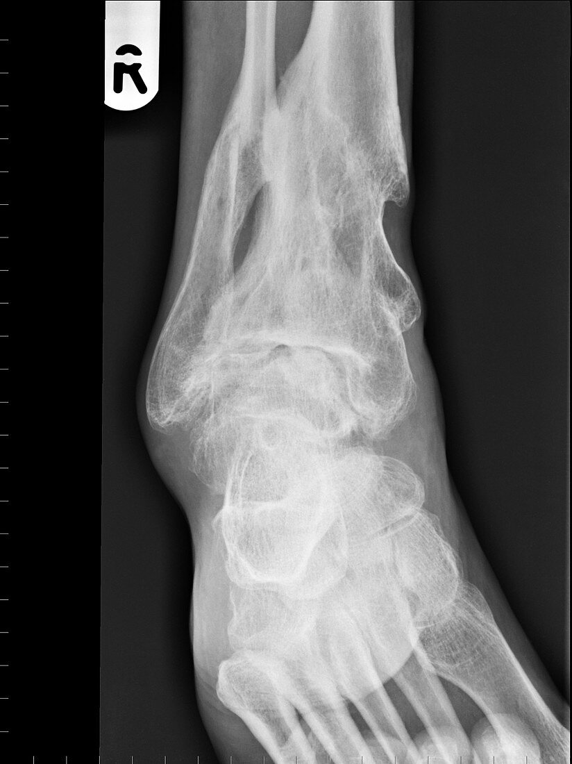 Arthritic foot and healed fracture,X-ray