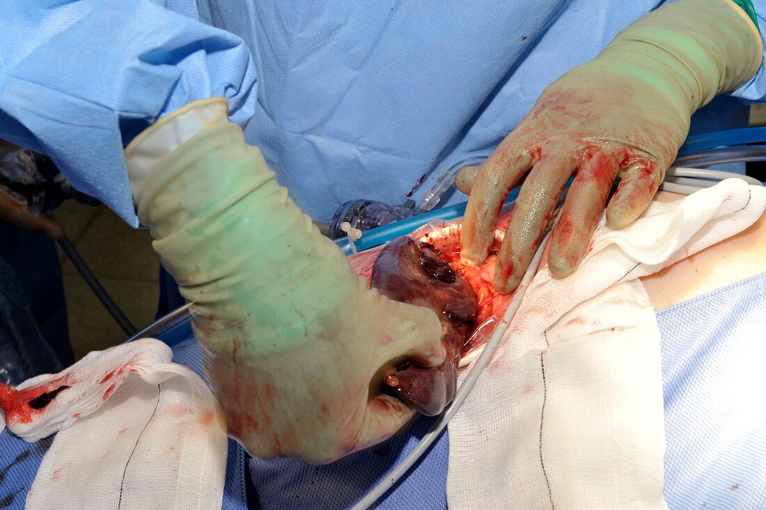 Spleen removal surgery