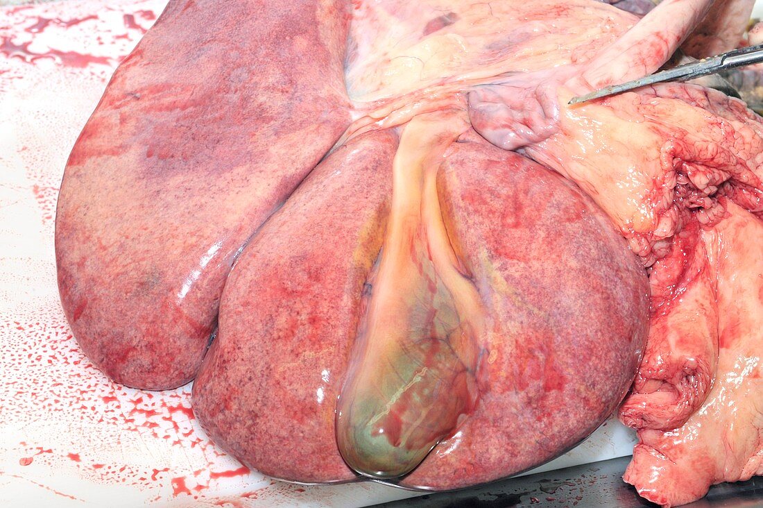 Gall bladder and liver,post-mortem
