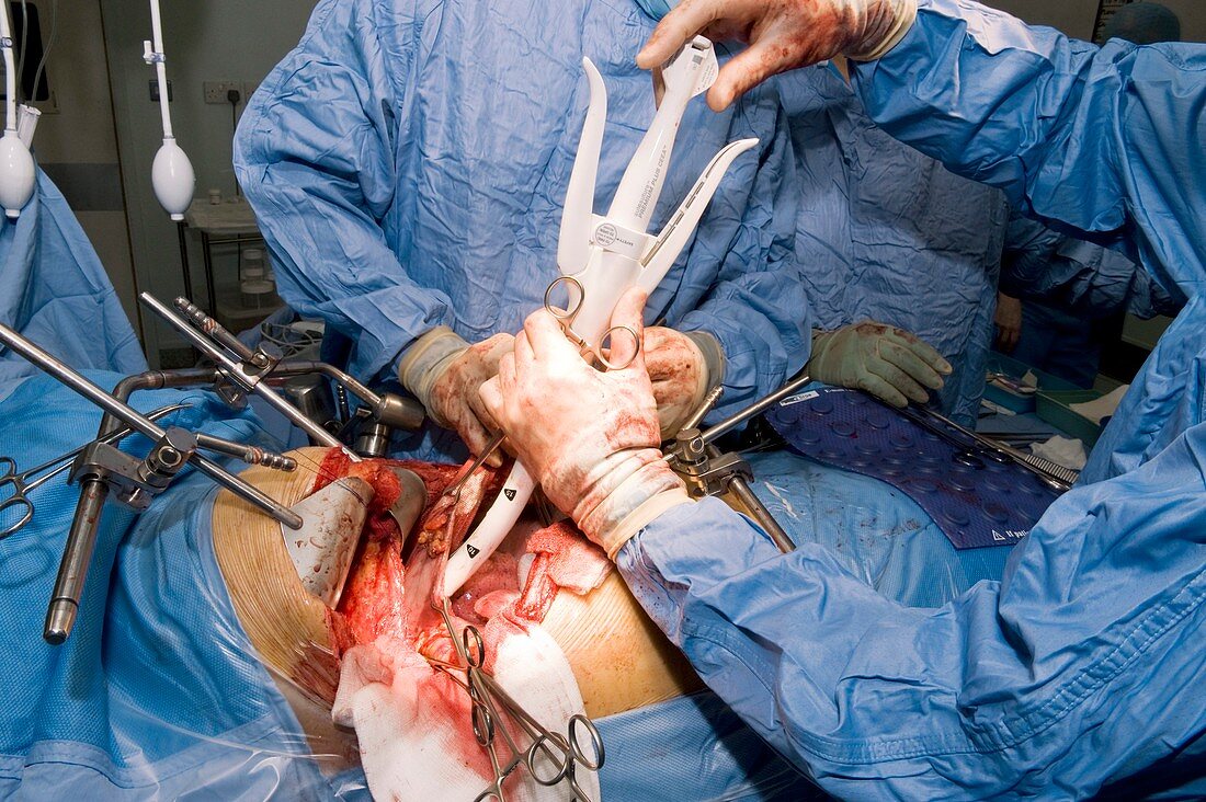 Oesophageal cancer surgery