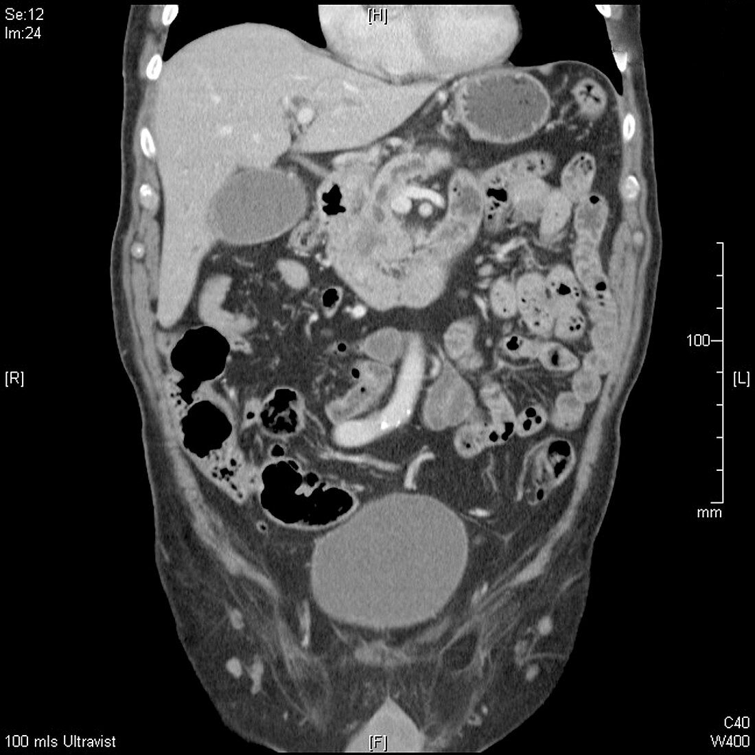 Pancreatic cancer,CT scan