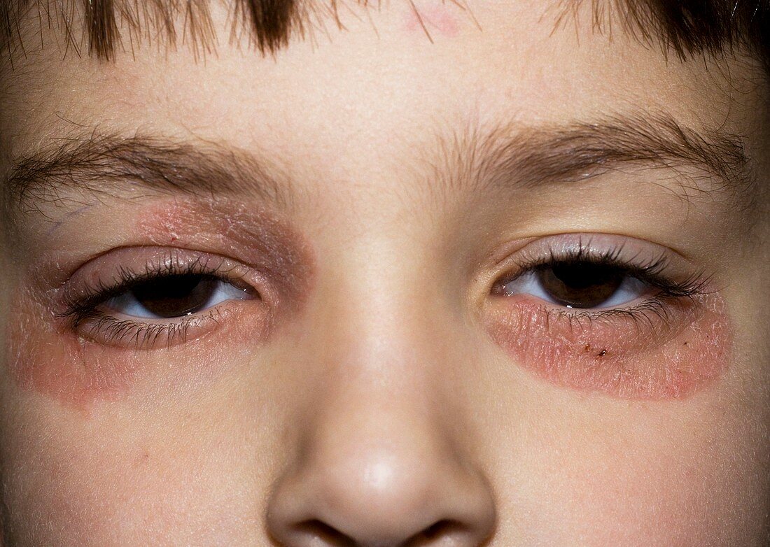 Psoriasis around the eyes