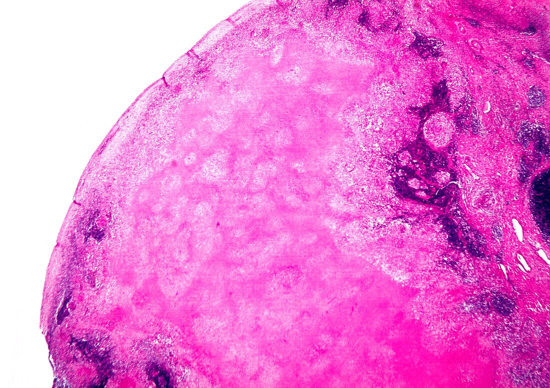 Tuberculous lymph node,light micrograph