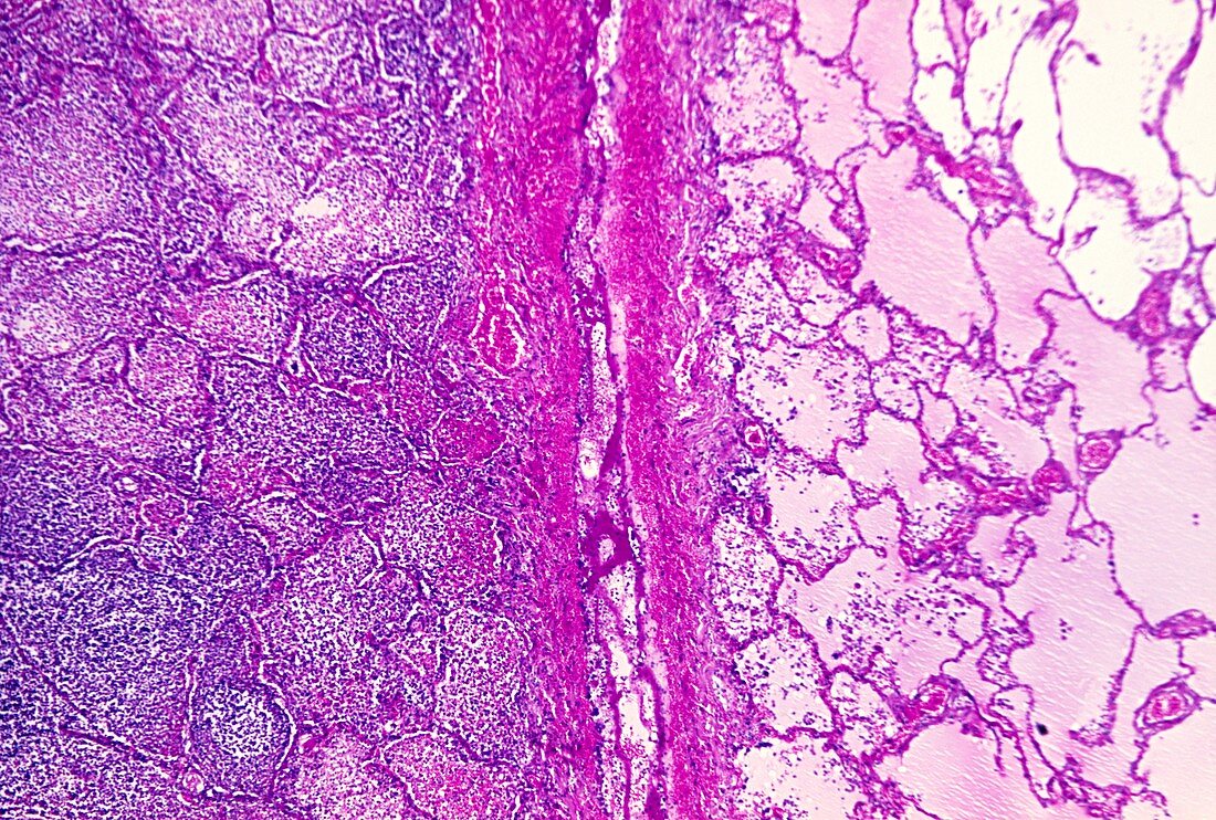 Lobar pneumonia,light micrograph