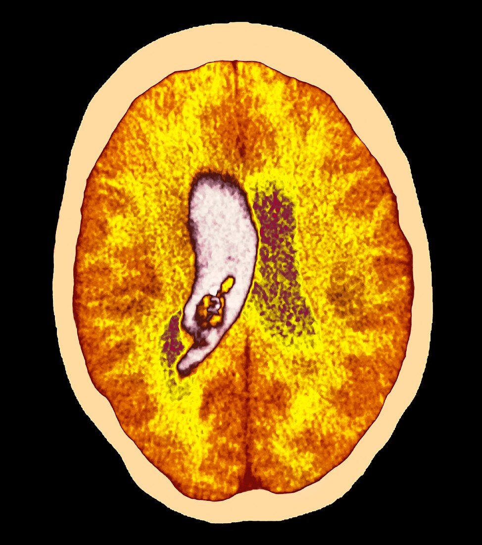 Brain haemorrhage,CT scan