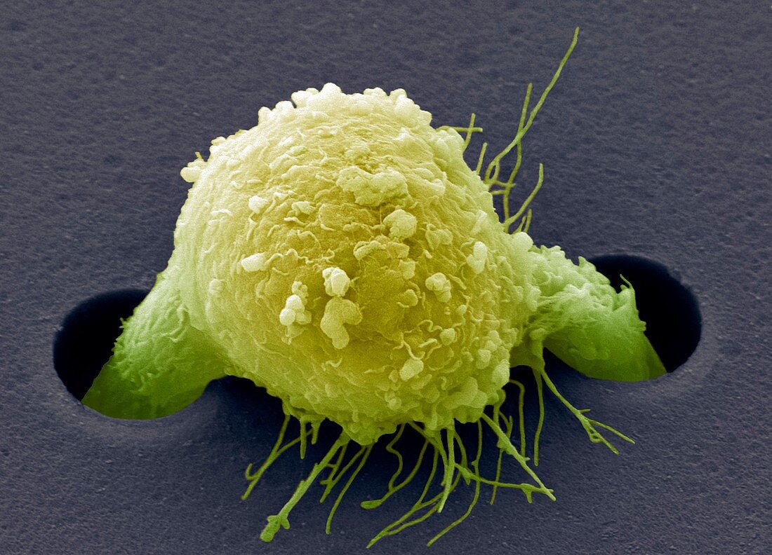 Migrating breast cancer cell,SEM