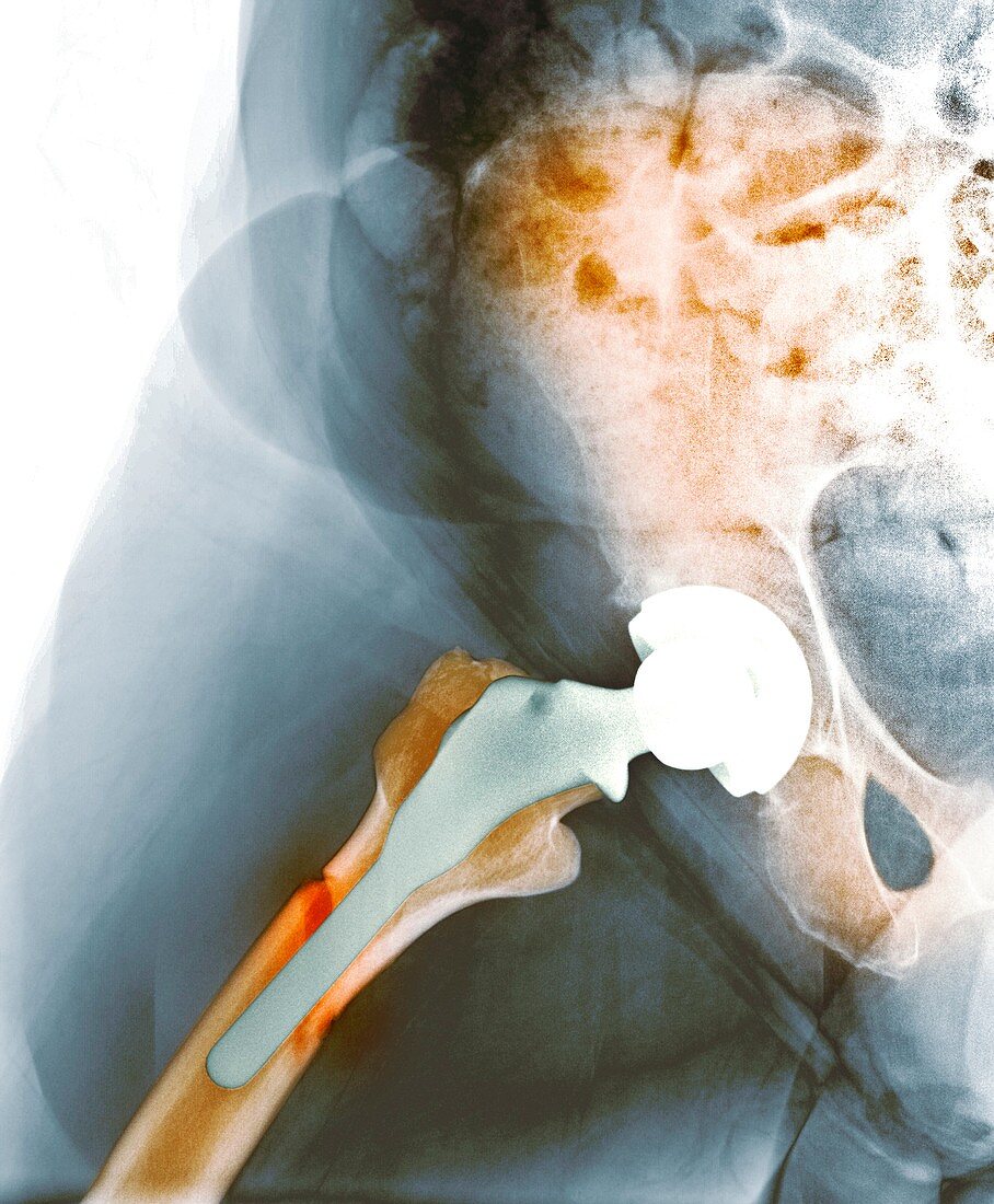 Failed hip resurfacing,X-ray