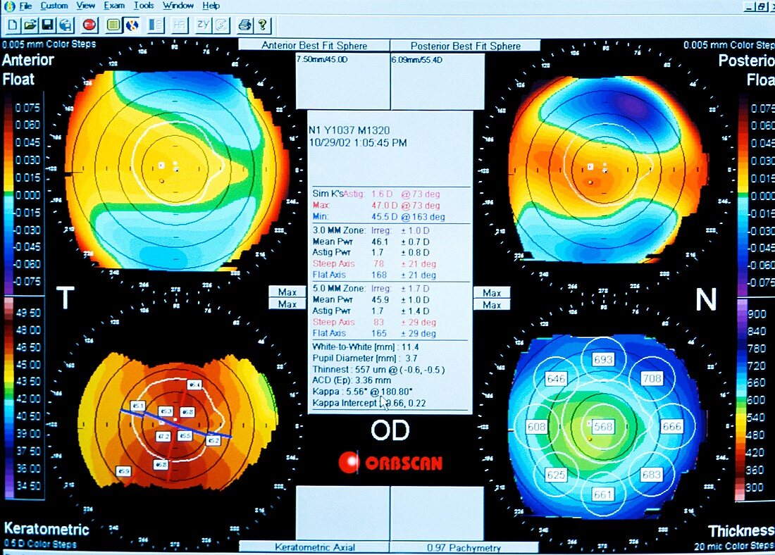 Corneal mapping after laser eye surgery