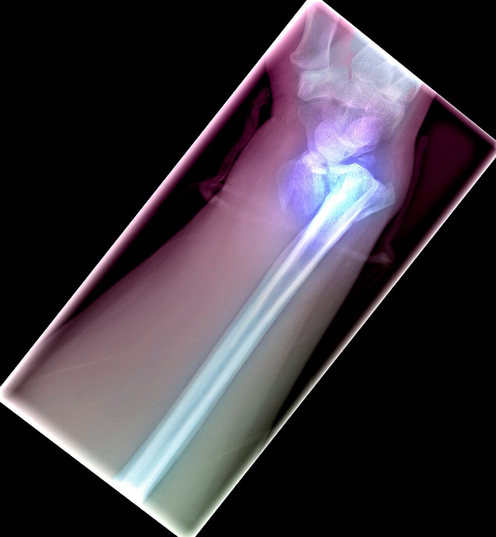 Broken wrist,X-ray