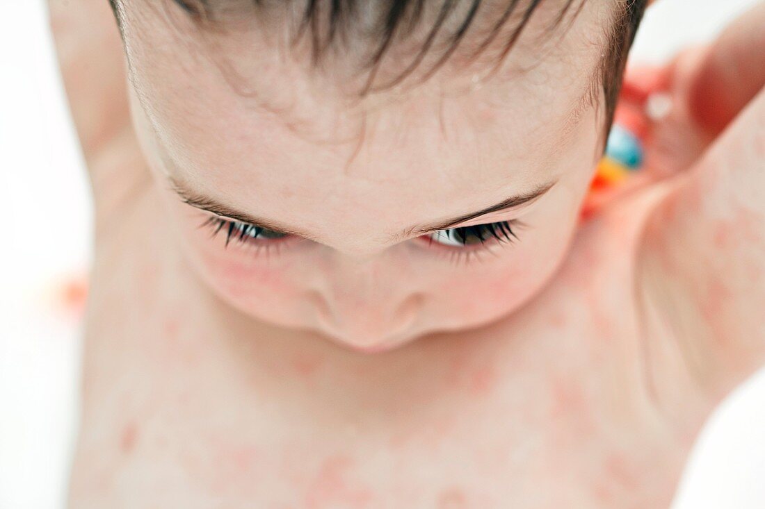 Young boy with eczema