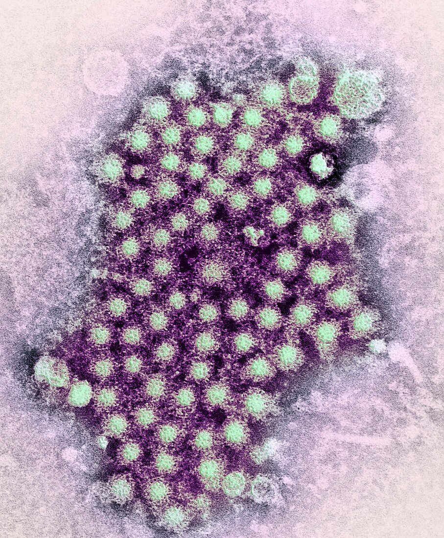 Hepatitis virus particles,TEM