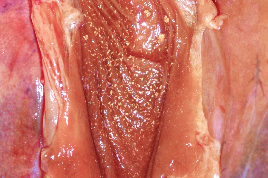 Gallbladder cholesterolosis,post-mortem
