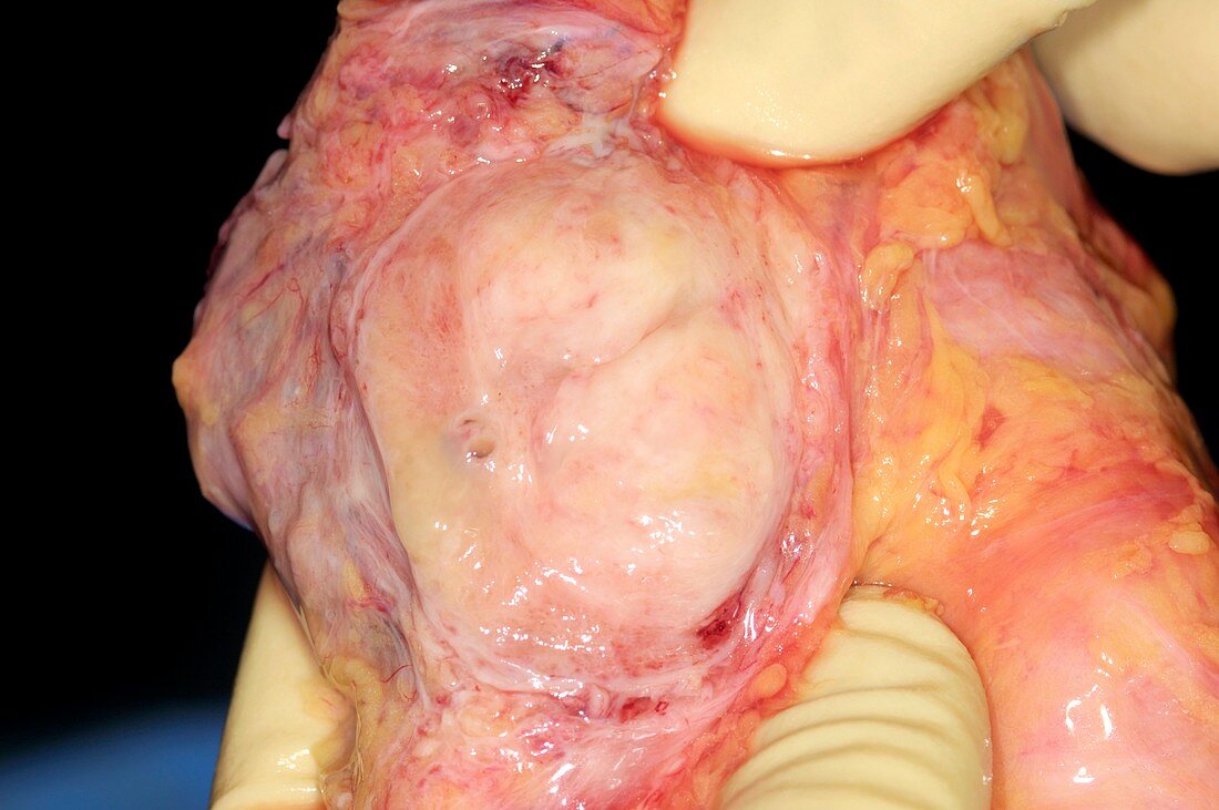 Prostate,post-mortem