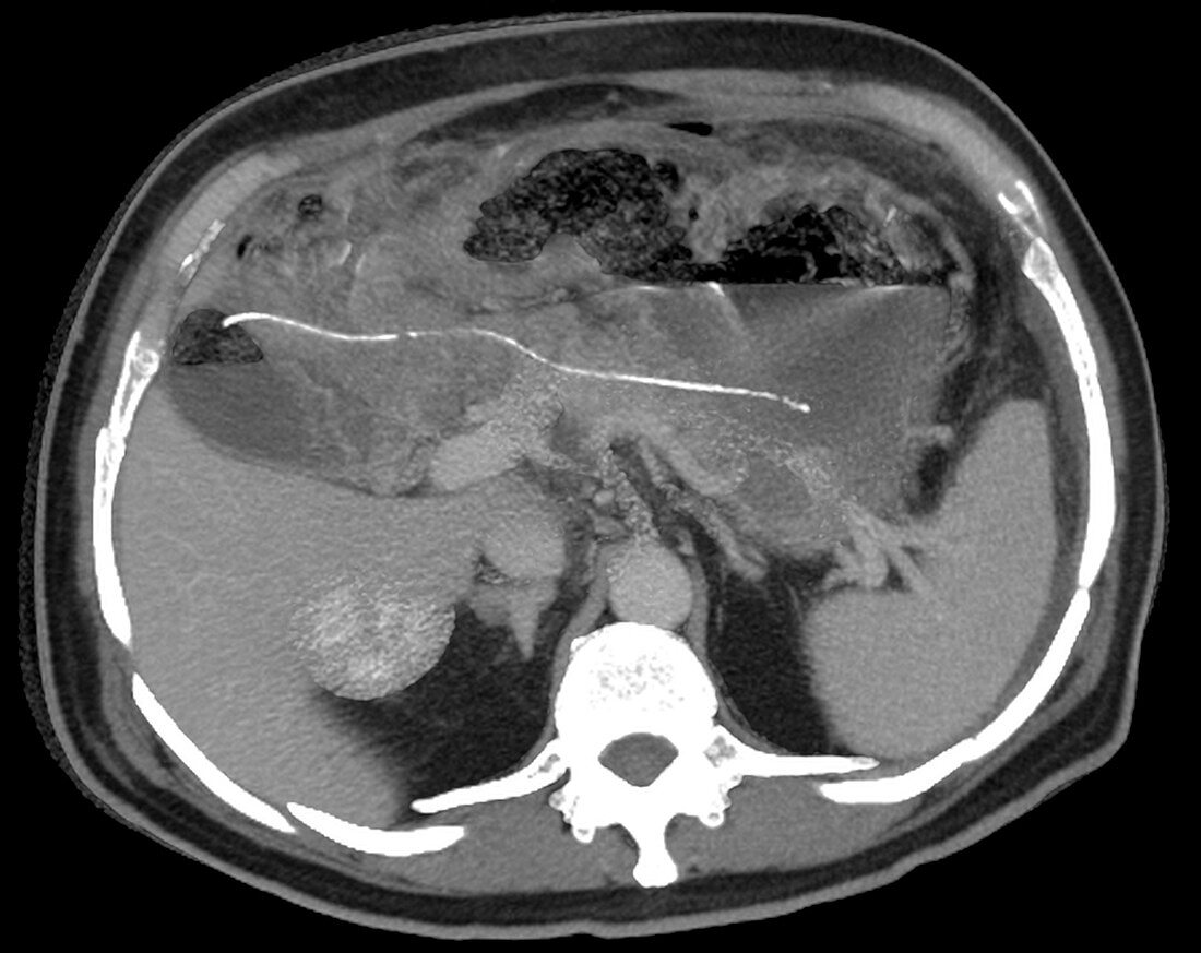 Ectopic pancreatic stent,CT scan