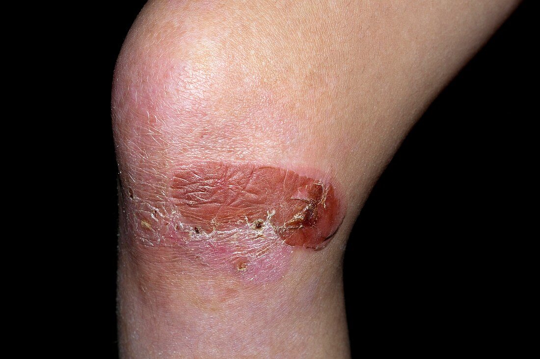 Epidermolysis bullosa skin disease