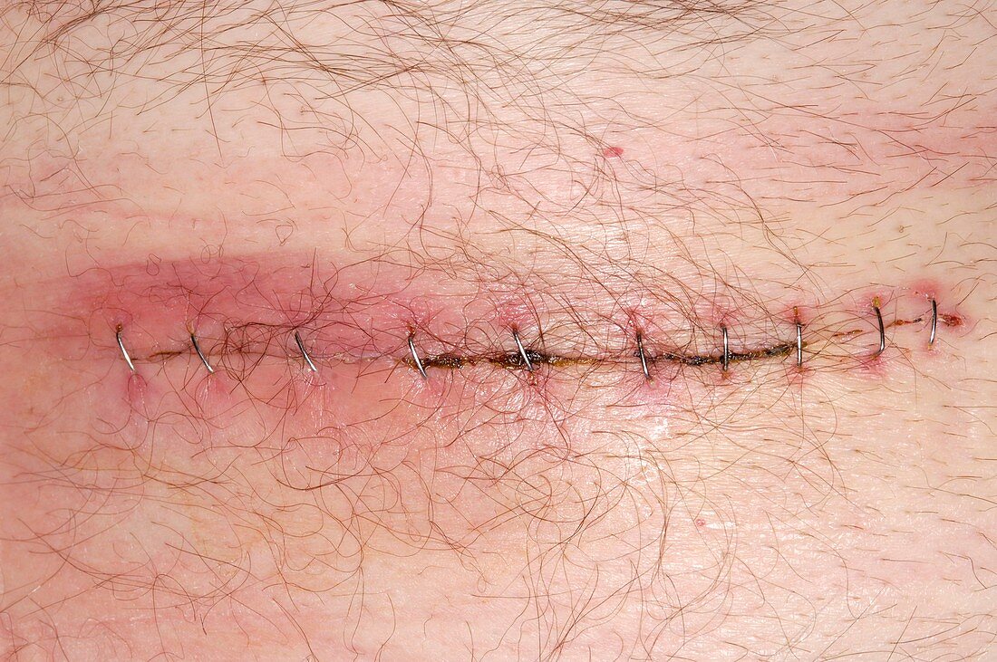 Infected appendix surgery wound