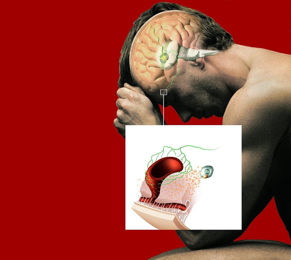 Migraine mechanisms,artwork