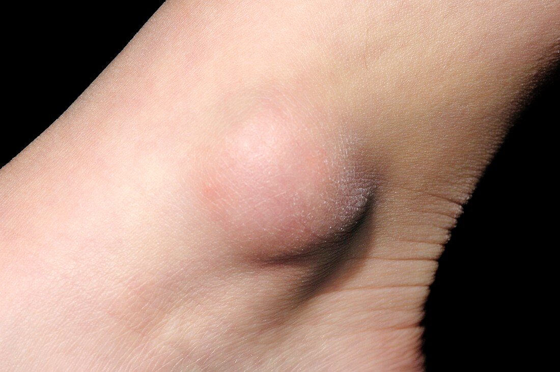 Bursitis of the ankle