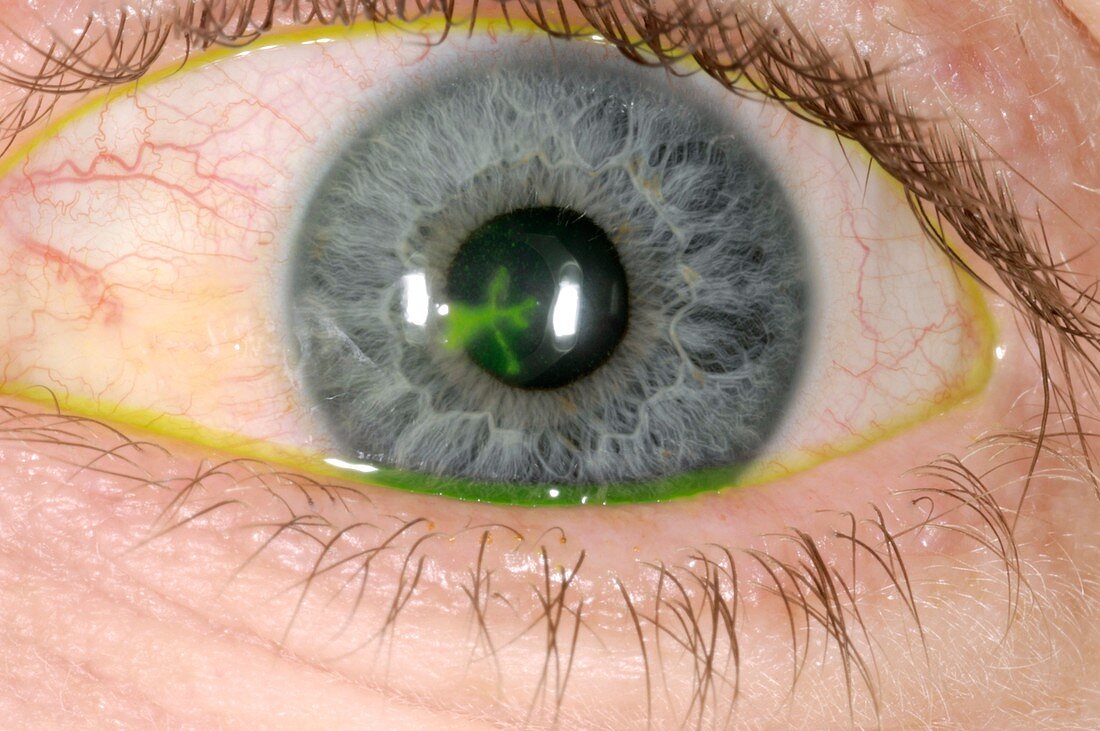 Eye ulcer