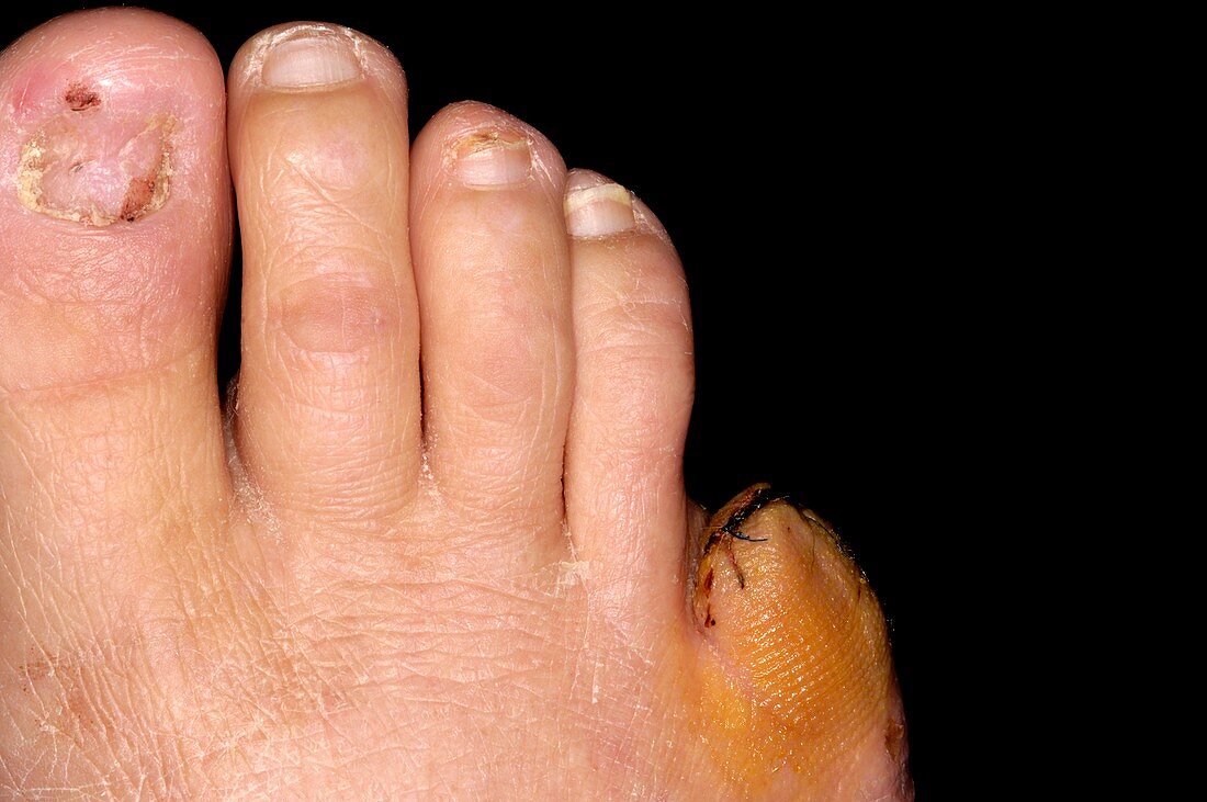 Amputated toe