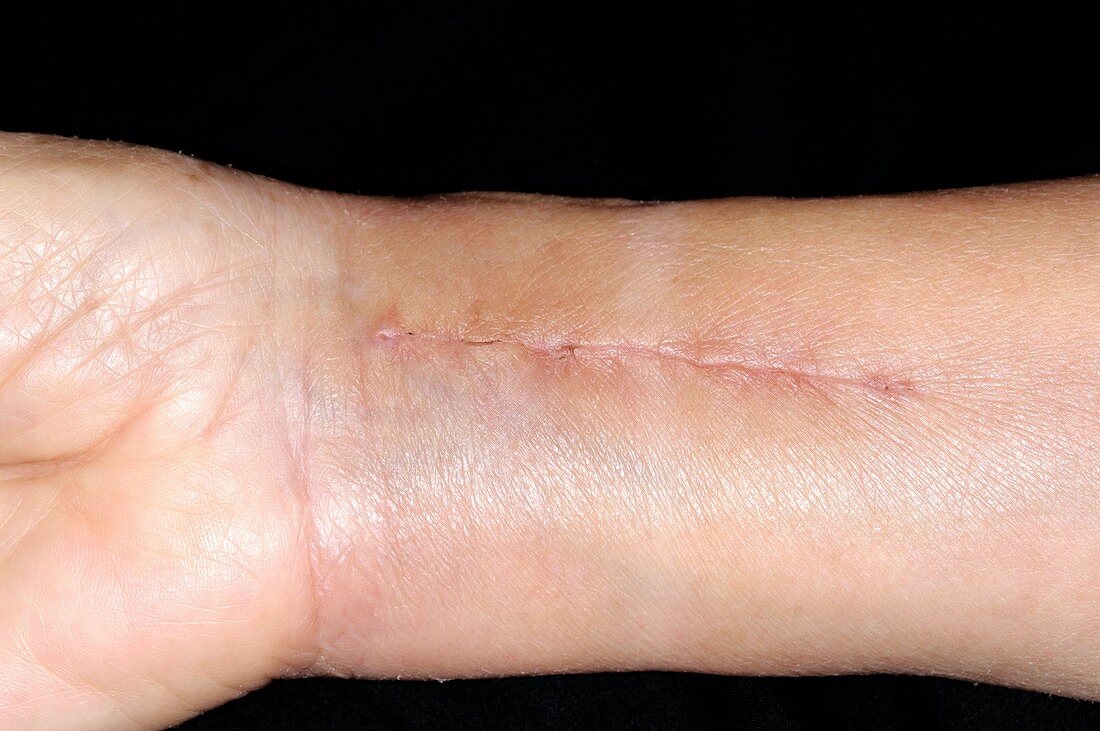 Fracture repair scar