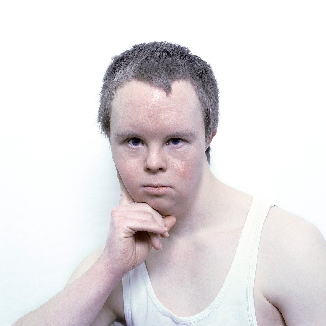Face of a man with Down's syndrome